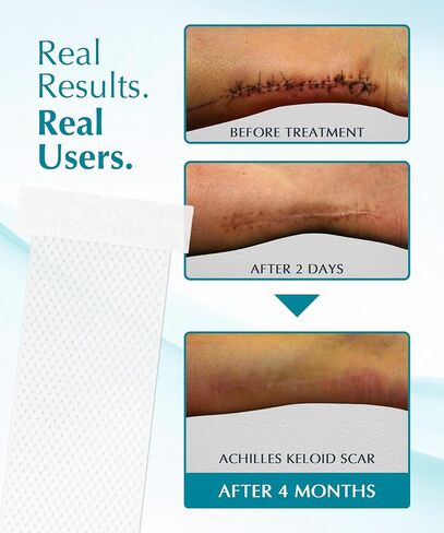 NewGel Plus Silicone Scar Tape Roll by MyNewGel – 100% Medical-Grade Silicone Scar Sheet for Surgery, C-Section, Keloid & Acne Scars – Extra Thick 1mm Tape – Made in USA – 1.5" x 96" in Kuwait