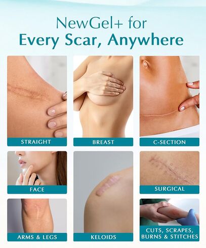 NewGel Plus Silicone Scar Tape Roll by MyNewGel – 100% Medical-Grade Silicone Scar Sheet for Surgery, C-Section, Keloid & Acne Scars – Extra Thick 1mm Tape – Made in USA – 1.5" x 96" in Kuwait