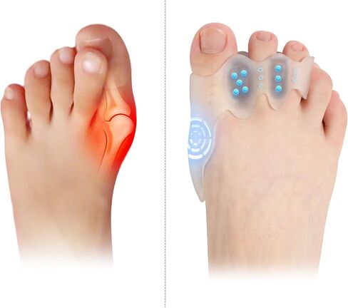 Toe Spacers & Bunion Corrector for KidsMenWomen|Corn Callus Removers|Bunion Relief|Overlapping Toes Separators (Toe Corrector Set (2 Pair, 40 ct Fillers), Large-Teens/Adults) in Saudi Arabia