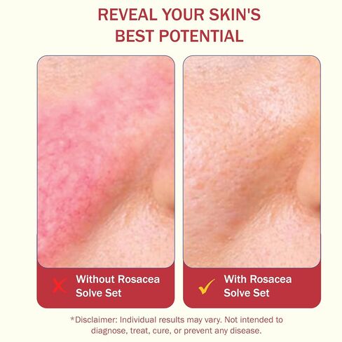 HealFast Rosacea Set - Includes Rosacea Cream, Face Wash, and Serum in Saudi Arabia