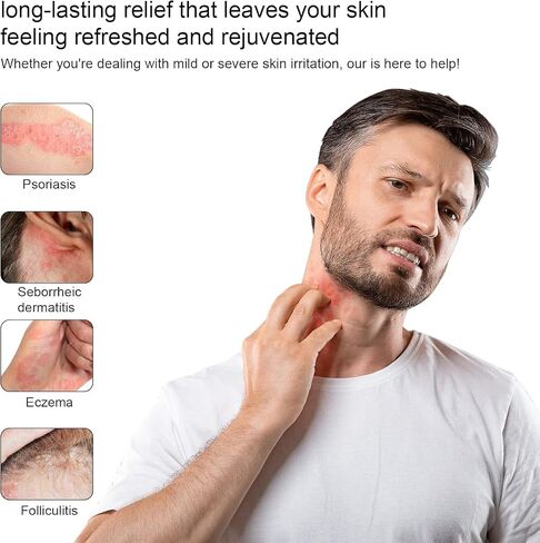 High Strength Bee Venom Cream, Dyshidrotic Eczema Ointment, Heat Rash, Itching, Eczema, Psoriasis, Leg, Stomach, Foot, Hand, Irritated Skin, All Age Care in Saudi Arabia