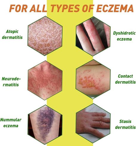 High Strength Bee Venom Cream, Dyshidrotic Eczema Ointment, Heat Rash, Itching, Eczema, Psoriasis, Leg, Stomach, Foot, Hand, Irritated Skin, All Age Care in Saudi Arabia