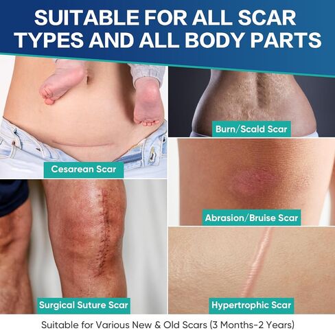 30PCS Medical Grade Silicone Scar Sheets, Advanced Scar Treatment & Prevention for Surgical, Burn, Hypertrophic & Keloid Scars, Flexible & Discreet Strips(1.2"x6") in Saudi Arabia