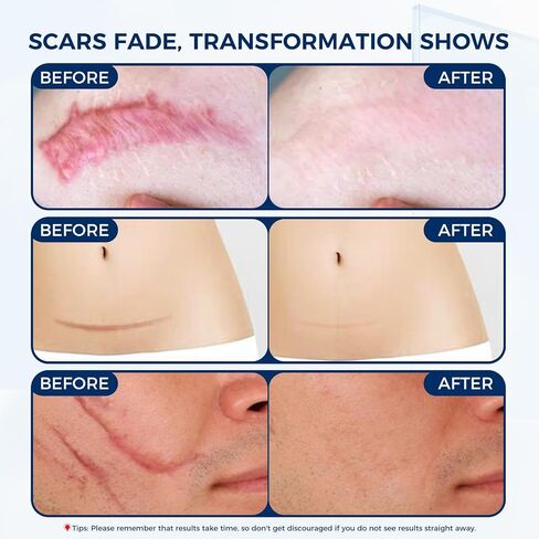 OUKEYA Silicone Scar Gel - 100% Silicone Cream Perfect for Sensitive Skin, Say Goodbye to Old and New Scars (30ml) in Kuwait