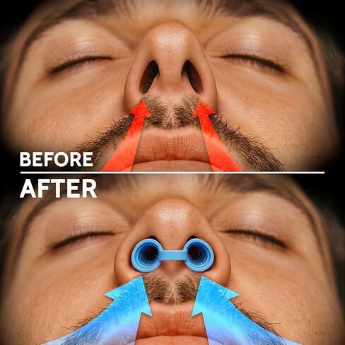 RETRO ELITE Set of Nose Vents - Effective Snoring Solution - Nasal Dilators, Anti Snoring Devices - Snore Stopper - Sleep Improvement - Relieve Nasal Congestion Due to Deviated Septum, Blue in Saudi Arabia