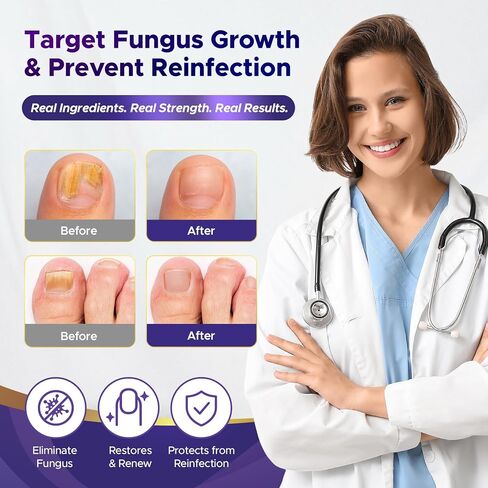 Toenail Fungus Treatment : Extra Strength 25% Undecylenic Acid Toe and Fingernail Fungus Removal - Fast Acting Fungal Nail Revitalizer with Tea Tree Oil (0.5 Fl Oz (Pack of 2)) in Kuwait