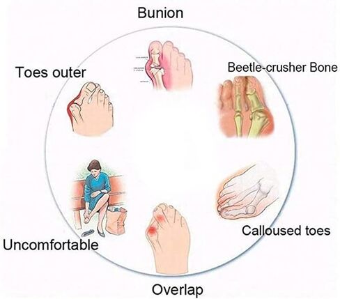 Comfy Split Toe Walking Sandals Bunion Corrector for Women Big Toe, Summer Outdoor Sandals for Women Bunion Relief in Kuwait