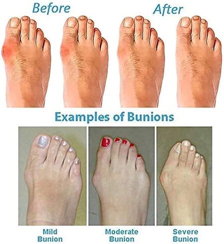 Comfy Split Toe Walking Sandals Bunion Corrector for Women Big Toe, Summer Outdoor Sandals for Women Bunion Relief in Kuwait
