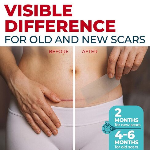 Medical Grade Silicone Scar Tape - 1.6"x70" - Effective Removal of Surgical, Keloid, C-Section, Tummy Tuck, Hypertrophic and Acne Scars - Easy to Use Treatment - Reusable Silicone Scar Sheets in Saudi Arabia