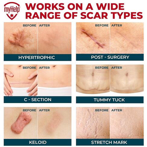 Medical Grade Silicone Scar Tape - 1.6"x70" - Effective Removal of Surgical, Keloid, C-Section, Tummy Tuck, Hypertrophic and Acne Scars - Easy to Use Treatment - Reusable Silicone Scar Sheets in Saudi Arabia