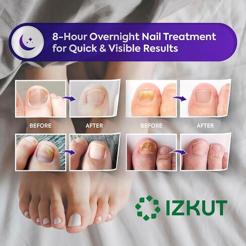 Toenail Fungus Treatment Extra Strength: Nail Fungus Treatment Patches for Toenail and Fingernails - 8-Hour Nighttime Renewal with 1% Tolnaftate - 32 Patches in Saudi Arabia