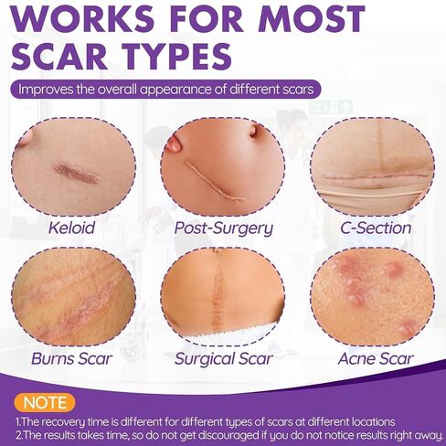 Silicone Scar Sheets, Silicone Scar Tape(1.6"x 118" Roll-3M), Reusable Professional Scar Silicone Strips, Soft Silicone Scar Sheets for Surgical Scars,Keloid,Acne Scars,Burn Scar,C-Section in Saudi Arabia