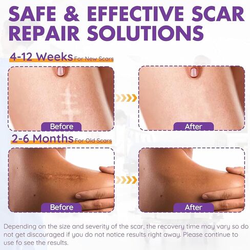 Silicone Scar Sheets, Silicone Scar Tape(1.6"x 118" Roll-3M), Reusable Professional Scar Silicone Strips, Soft Silicone Scar Sheets for Surgical Scars,Keloid,Acne Scars,Burn Scar,C-Section in Saudi Arabia