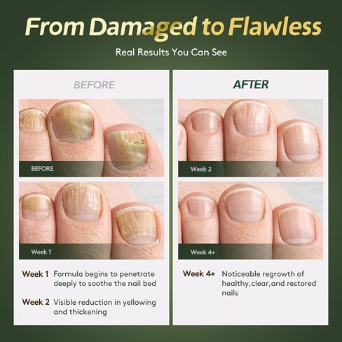 Toenail Fungus Treatment Extra Strength【Max Strength Tea Tree Oil & Undecylenic Acid】Fungus Nail Treatment Liquid Maximum Strength【3-Day Fast Relief】Antifungal Foot & Toe Nail Repair Drops in Kuwait