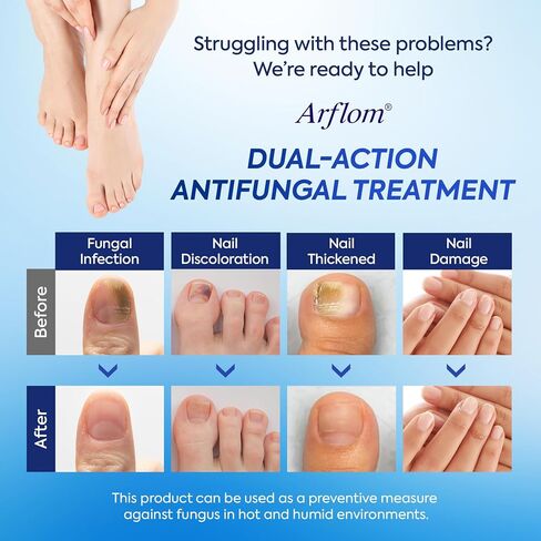Toenail Fungus Treatment Kit: 2 Pcs Extra Strength 25% Undecylenic Acid Solution & 14 Fungal Nail Renewal Patches - for Toe Nail & Fingernail with Tea Tree Oil (0.51 Fl Oz (Pack of 2)) in Kuwait