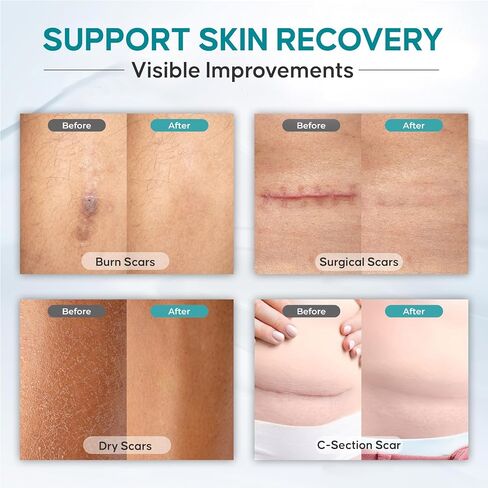 Silicone Scar Tape for Scar Treatment, Silicone Scar Sheets for Surgical Scars, C Section Scar Silicone Strips, Silicone Tape Medical Grade Aloe Vera Scar Tape, for Face and Body | 1.6" x 48" | in Saudi Arabia