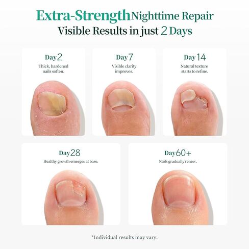 APUREE Fungal Nail Patches Extra Strength: Max 1% Tolnaftate | FSA-HSA | 8H Overnight Toenail Treatment |Repair For Discolored Yellow Brittle Damage Nails| Restores Healthy Appearance| 32 Patch in Kuwait