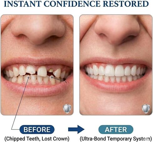 Tooth Repair Kit Zinc Oxide Eugenol Cement Dental Care Kit, Temporary Teeth Replacement, Dental Care Repair for Broken Chipped Teeth, Crown Fillings & Bridges 2PCS in Saudi Arabia