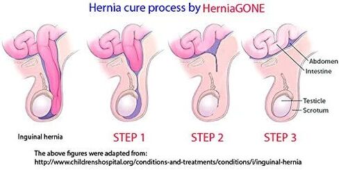 HerniaGONE for Adult, 2 Pack - Essential Oil Blend, Easy to Apply topically, Tested for 50+ Years, Natural Remedy for Adult Hernias, Try it for 1-2 Weeks Before Seeing a Doctor in Saudi Arabia