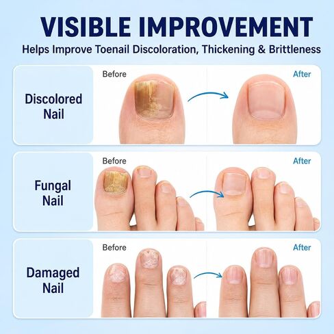 Nail Fungus Treatment Extra Strength: 25% Undecylenic Acid Formula – Toenail Fungus Treatment Kit with Brush & File for Ingrown Nails, Discoloration & Brittle Nails, Thick-Looking, Rough-Looking in Saudi Arabia