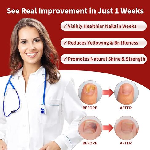 علاج فطريات أظافر قوة إضافية ، علاج فطريات الأظافر مع حمض undecylenic للأظافر والأظافر ، إصلاح الأظافر المضاد للفطريات للرياضيين ، نام ، سميكة ، مكسورة ، أظافر تالفة ، 30 مل ل. in Kuwait