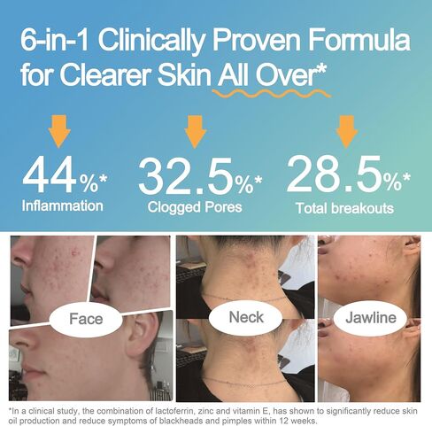 Life-Space Acne Relief + Skin Rebalance Probiotic, 6-in-1 Scientific Formula & 2 Billion CFU, Support Breakout Control & Skin Health & Gut Health, Probiotics for Women & Men, 30 Vegetarian Count in Kuwait