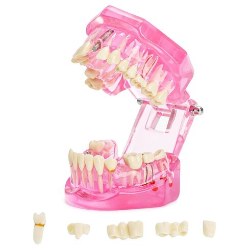 ZENFUN Disease Teeth Model with Dental Implant Bridge, Dental Model for Patient and Dental Student Education, Teeth Typodonts Analysis Demonstration Teeth Model Standard Size (Pink) in Kuwait