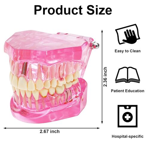 ZENFUN Disease Teeth Model with Dental Implant Bridge, Dental Model for Patient and Dental Student Education, Teeth Typodonts Analysis Demonstration Teeth Model Standard Size (Pink) in Kuwait