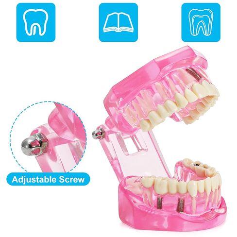 ZENFUN Disease Teeth Model with Dental Implant Bridge, Dental Model for Patient and Dental Student Education, Teeth Typodonts Analysis Demonstration Teeth Model Standard Size (Pink) in Kuwait