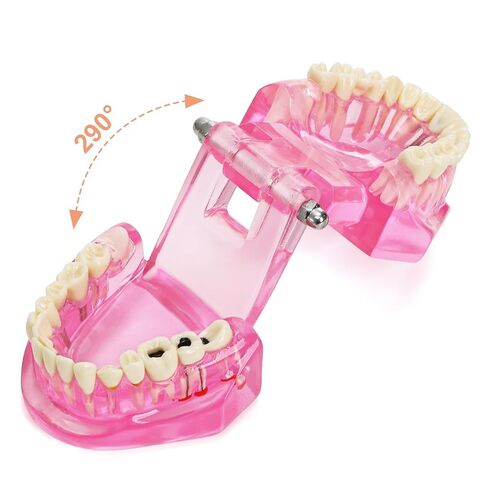 ZENFUN Disease Teeth Model with Dental Implant Bridge, Dental Model for Patient and Dental Student Education, Teeth Typodonts Analysis Demonstration Teeth Model Standard Size (Pink) in Kuwait
