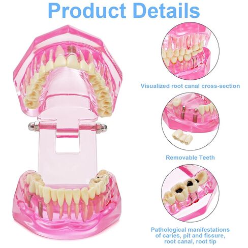 ZENFUN Disease Teeth Model with Dental Implant Bridge, Dental Model for Patient and Dental Student Education, Teeth Typodonts Analysis Demonstration Teeth Model Standard Size (Pink) in Kuwait