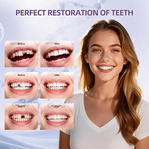 Tooth Repair Kit, Zinc Oxide Eugenol Cement for Cavities Filling, Dental Care Kit for Broken, Chipped or Missing Teeth, Temporary and Permanent Tooth Filling and Crown Fixing at Home in Kuwait