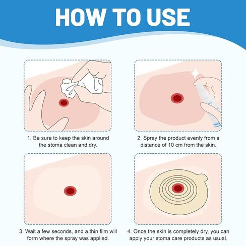 رذاذ حاجز الجلد Ostomy، رذاذ فيلم حاجز خالٍ من الكحول ولا يسبب اللسع للعناية بالفغرة، مستلزمات فغر القولون، حماية الجلد الطبية من الفغرة، مواد لاصقة، تمنع التسربات، 1 أونصة (30 مل) in Kuwait