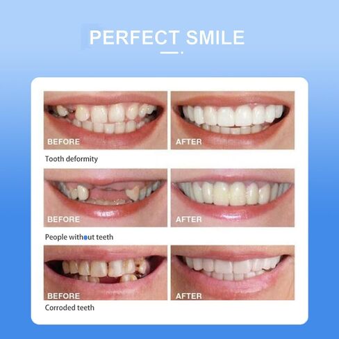 قشور Snap-On - مجموعة احترافية لتصحيح الابتسامة يمكنك صنعها بنفسك للرجال والنساء - مجموعة علوية وسفلية بيضاء مريحة وطبيعية - مثالية لإخفاء الفجوات والبقع والأسنان المفقودة - ملائمة للمنزل بسهولة in Kuwait