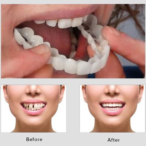 قشور Snap-On - مجموعة احترافية لتصحيح الابتسامة يمكنك صنعها بنفسك للرجال والنساء - مجموعة علوية وسفلية بيضاء مريحة وطبيعية - مثالية لإخفاء الفجوات والبقع والأسنان المفقودة - ملائمة للمنزل بسهولة in Kuwait
