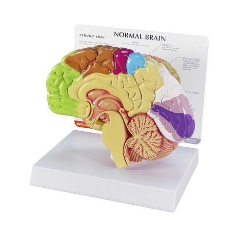 GPI Anatomicals نموذج الدماغ داخل الجمجمة الجزئية المصابة بالأمراض | نسخة طبق الأصل من جسم الإنسان وعلم التشريح لتعليم علم وظائف الأعضاء، نموذج تشريحي لمكتب الطبيب، مصادر التعلم الطبي in Kuwait