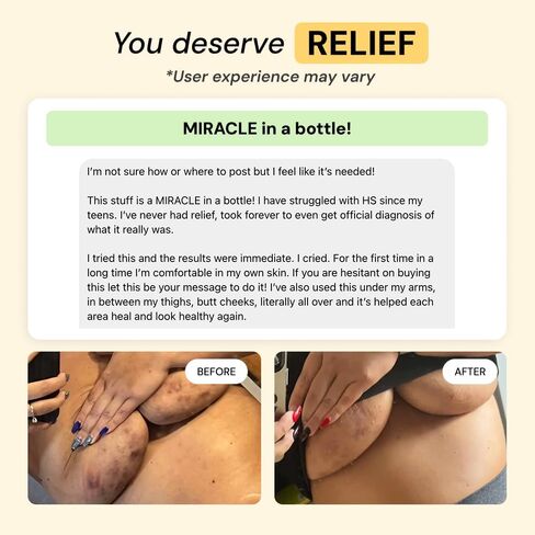 روتين MyMagicHealer HS Flare Care المكون من 3 خطوات - العناية اليومية بالتهاب الغدد العرقية القيحي والبشرة المتهيجة | مرهم الرسم للدمامل والخراجات | المكونات الطبيعية in Saudi Arabia
