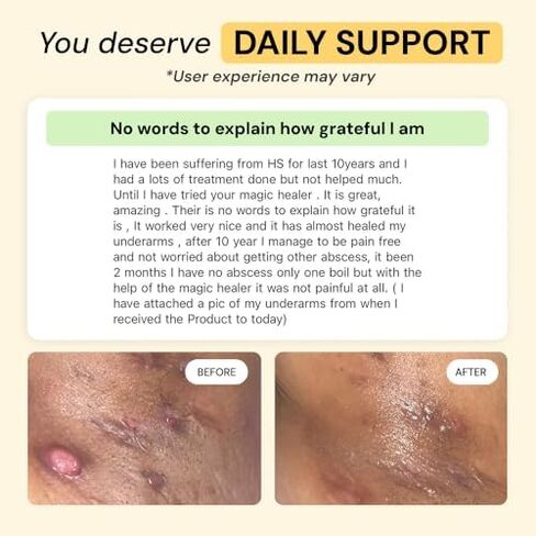 روتين MyMagicHealer HS Flare Care المكون من 3 خطوات - العناية اليومية بالتهاب الغدد العرقية القيحي والبشرة المتهيجة | مرهم الرسم للدمامل والخراجات | المكونات الطبيعية in Saudi Arabia