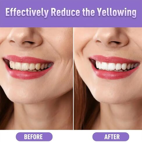 NomadNest Teeth Whitening Pen (4 Pcs) – Painless Teeth Whitener for Sensitive Teeth, Mint Flavor Whitening Gel, Removes Coffee & Tea Stains, Enamel-Safe, Travel-Friendly for a Brighter Smile in Kuwait