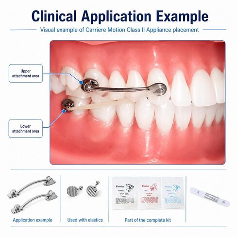 Orthodontic Class II Molar Distalizer Appliance Kit, Professional Dental Class II Correction Appliance with Lingual Buttons, Elastics, Ruler and Storage Box, 6 Size Options (Size 20mm) in Kuwait