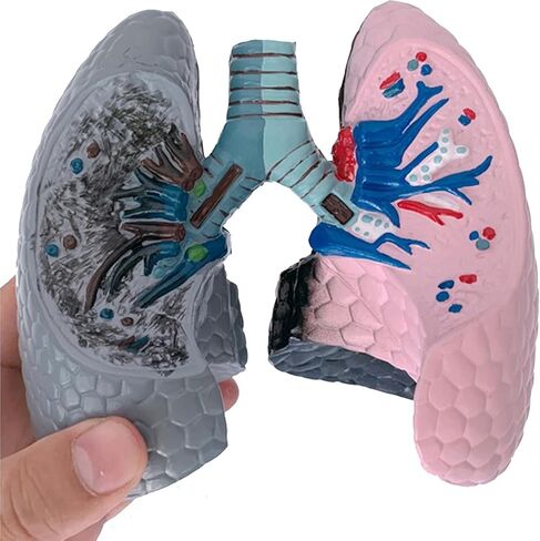 Human Health and Smoking Lung Comparison Model, Healthy VS Smoking Bronchopulmonary Anatomy Display, with English Back Card, for Health Education in Kuwait