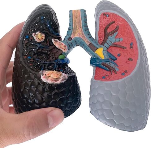 Human Health and Smoking Lung Comparison Model, Healthy VS Smoking Bronchopulmonary Anatomy Display, with English Back Card, for Health Education in Kuwait