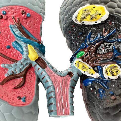 Human Health and Smoking Lung Comparison Model, Healthy VS Smoking Bronchopulmonary Anatomy Display, with English Back Card, for Health Education in Kuwait