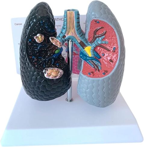 Human Health and Smoking Lung Comparison Model, Healthy VS Smoking Bronchopulmonary Anatomy Display, with English Back Card, for Health Education in Kuwait