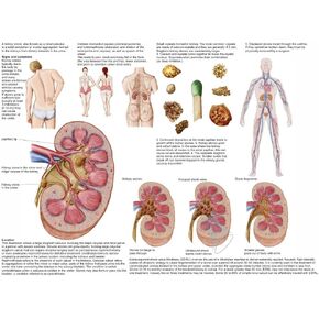 Medical chart showing the signs and symptoms of kidney stones Poster Print (16 x 12) in Saudi Arabia