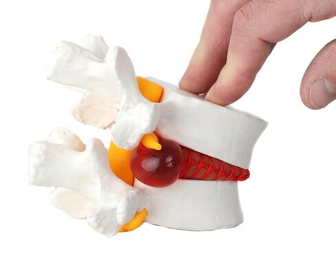 Axis Scientific Human Lumbar Herniating Disc Demonstration Anatomy Model | for Teaching and Learning, Human anatomy system miniature, scientific anatomy model in Kuwait