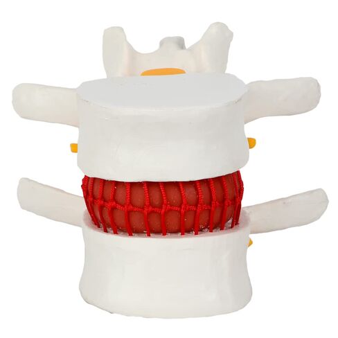 Axis Scientific Human Lumbar Herniating Disc Demonstration Anatomy Model | for Teaching and Learning, Human anatomy system miniature, scientific anatomy model in Kuwait