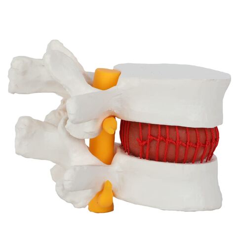 Axis Scientific Human Lumbar Herniating Disc Demonstration Anatomy Model | for Teaching and Learning, Human anatomy system miniature, scientific anatomy model in Kuwait