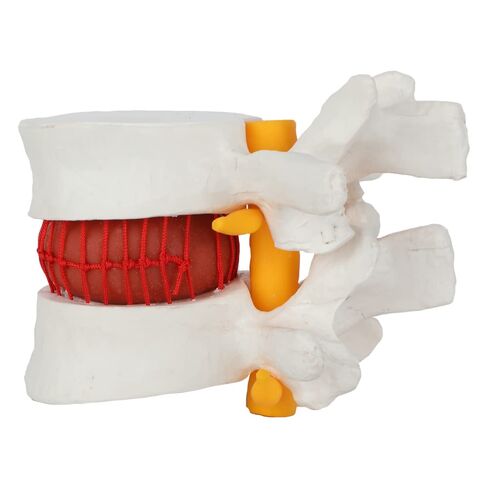 Axis Scientific Human Lumbar Herniating Disc Demonstration Anatomy Model | for Teaching and Learning, Human anatomy system miniature, scientific anatomy model in Kuwait