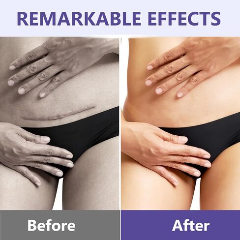 Keloid Bump Removal, Silicone Gel Hydrating Cream for Skin Bumps and Marks | Scar gel-cream intensely hydrates, softens uneven skin texture, for Face & Body in Kuwait